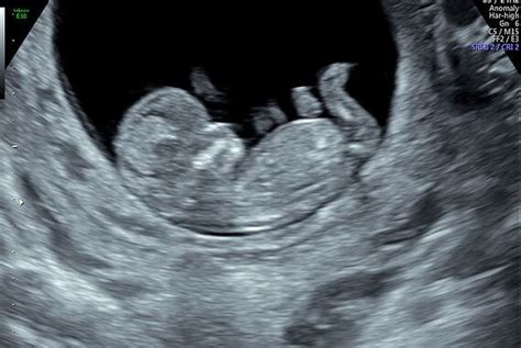 how accurate is dating scan at 11 weeks