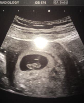 how accurate is dating scan at 7 weeks