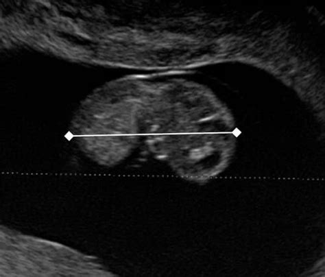 most accurate dating ultrasound
