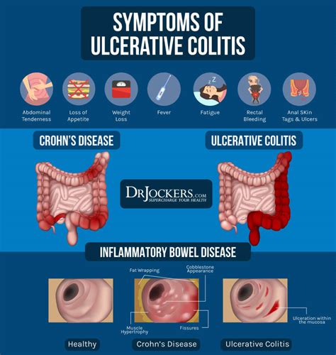 ulcerative colitis and dating