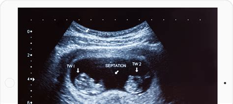 us obstetric dating scan viability
