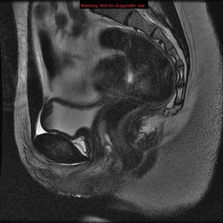Agenesis General Radiology Reference Article Radiopaedia Org Agenesia Rtp - Agenesia Rtp