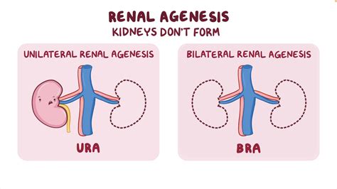 Renal Agenesis Video Anatomy Definition Amp Function Osmosis Agenesia - Agenesia