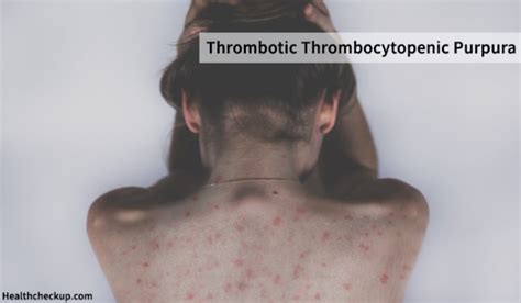 Thrombotic Thrombocytopenic Purpura Symptoms Amp Treatment Dompettoto - Dompettoto