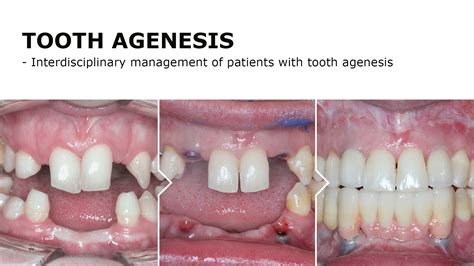 Tooth Agenesis An Overview Of Diagnosis Aetiology And Agenesia Resmi - Agenesia Resmi
