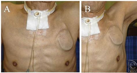 Figure From Efficacy And Feasibility Of The Submuscular Implantation