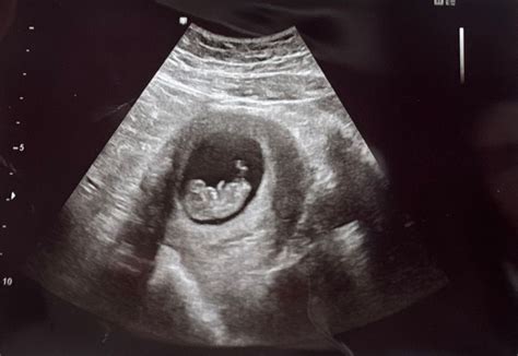 Week Ultrasound September Babies Forums What To Expect