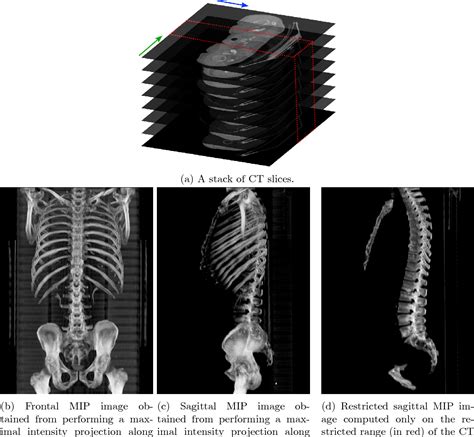 Figure 1 From Automatic L3 Slice Detection In 3d Ct Images Using Fully Convolutional Networks