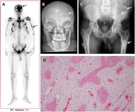 Figure 1 From Polyostotic Fibrous Dysplasia Mimicking Metastatic