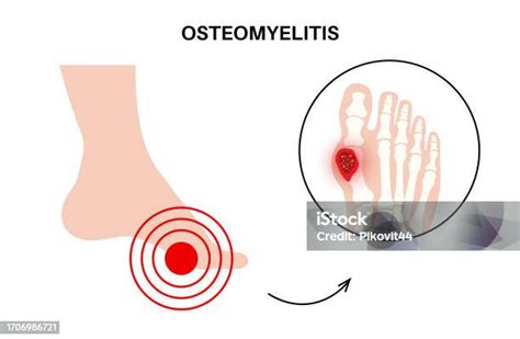 Osteomyelitis Of Feet Stock Illustration Download Image Now Acute Angle Anatomy Ankle Istock