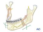 Treatment of Mandibular retrognathism