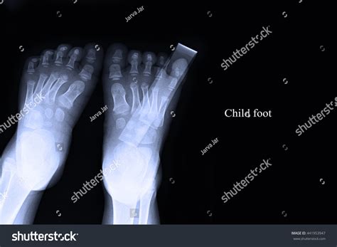 Xray Both Foot Child Foot Show Stock Photo (Edit Now) 441953947