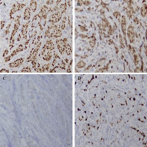 Figure 2 Immunohistochemistry Of Luminal B Invasive Breast