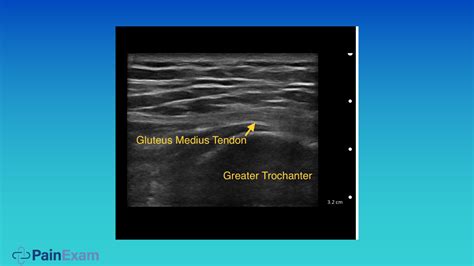 Video Pain Management Case Study Treating Severe Pain With A Gluteal