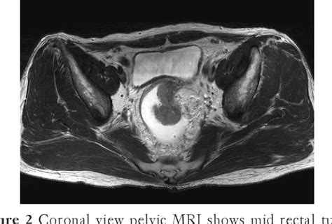 Rectal reconstruction