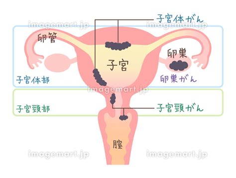 子宮がん・卵巣がんのイラスト・図説（文字あり） 130812013 イメージマート