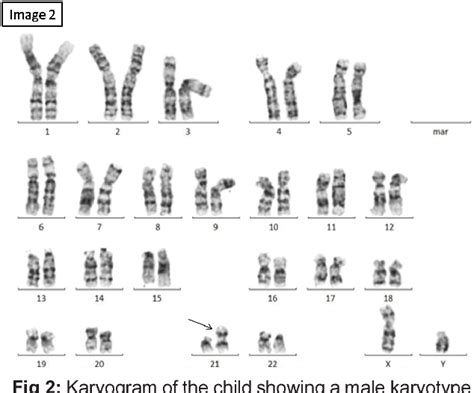 Pdf De Novo Robertsonian Translocation T21 21 In A Child With Down