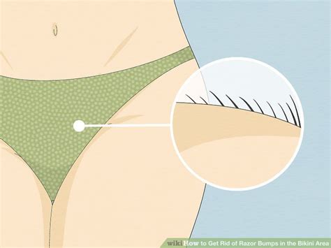 4 Ways To Get Rid Of Razor Bumps In The Bikini Area WikiHow
