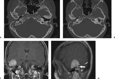 The Vestibulocochlear Nerve With An Emphasis On The Normal And