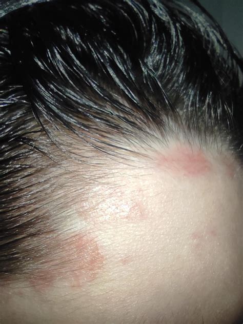 rash on scalp/forehead ?? : r/medical_advice