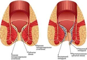Геморроидальные узлы: как лечить геморройные шишки