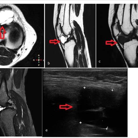 Chondromalacia patellae grades II–IV in various patients. (A) Axial... | Download Scientific Diagram