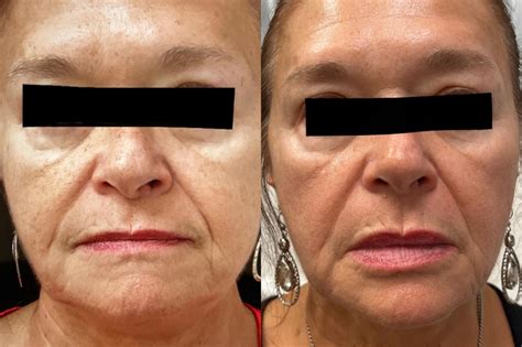 Dermal Fillers Before And After Pictures Case 10 Port Richey FL