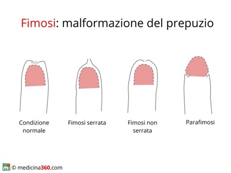 Fimosi640x480 Prostatite 2002