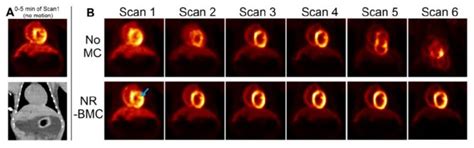 Motion Correction Enables Quantitative Pet Scans Physics World