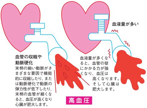 『高血圧』ってどんな病気？ 日本臨床内科医会