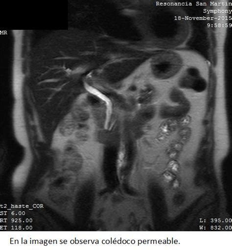 Pancreatitis Recurrente Secundaria A Disfunci N Del Esf Nter De Oddi