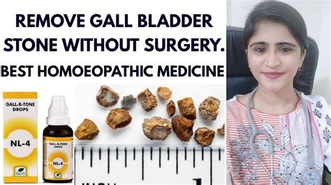 Gall Bladder Stone Homoeopathic Medicine For Gall Bladder Stone Remove Stone Without Surgery