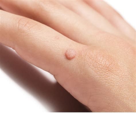 Flat Warts What They Look Like And How To Treat The Them