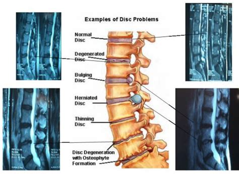 Ozonoterapia Ernia Del Disco Ossigeno Ozono Terapia