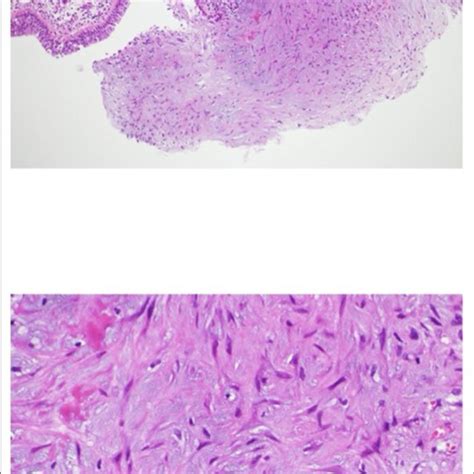 Findings In Biopsy Specimen From The Hemorrhagic Polypoid Lesion The