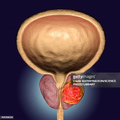 Prostate Cancer Anatomy Photos And Premium High Res Pictures Getty Images