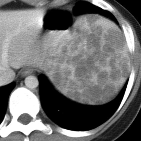 Focal Cystic Abdominal Masses In Pediatric Patients Ajr