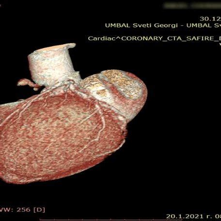 Curved Reformat Of CTCA Demonstrating Calcified Plaques In The Proximal