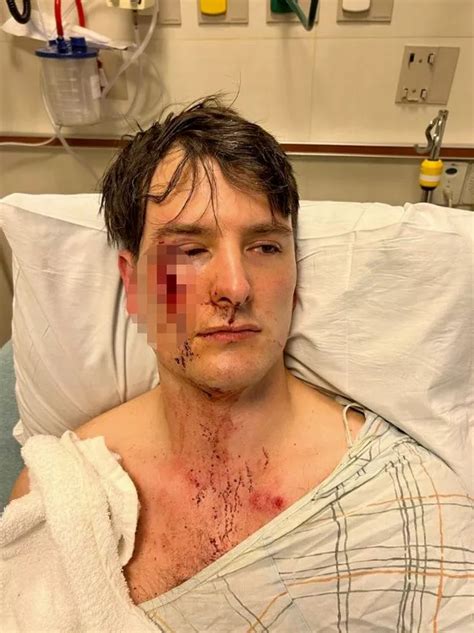 Gay Couple Beaten Outside Bar They Own But Police Say It Wasn T A Hate Crime The Mirror