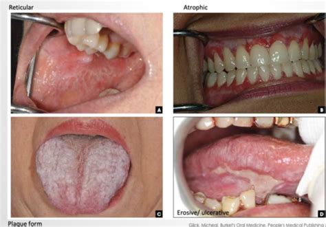 Case Oral Lichen Planus Flashcards Quizlet