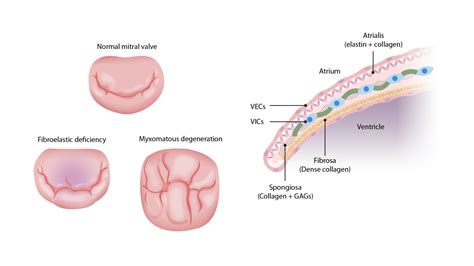 Mitral Valve Prolapse | Concise Medical Knowledge