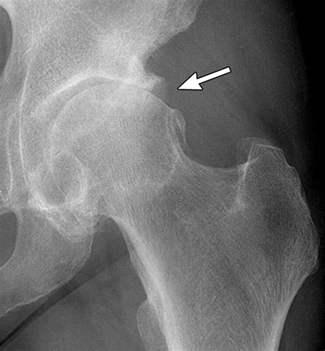 Normal hip xray pathologic fracture hip xray - tokyotere