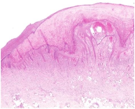 Histopathologic Analysis Of A Skin Biopsy Specimen From A Year Old