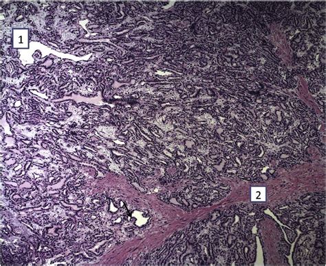 Hande Stain Of Papillary Cystadenoma Of The Epididymis Epididymal Duct Download Scientific