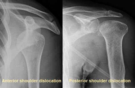 Anterior Vs Posterior Shoulder Dislocation Xr