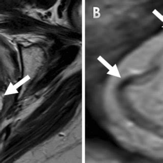 Schematic Illustration Of VRAM Flap Harvest And Reconstruction