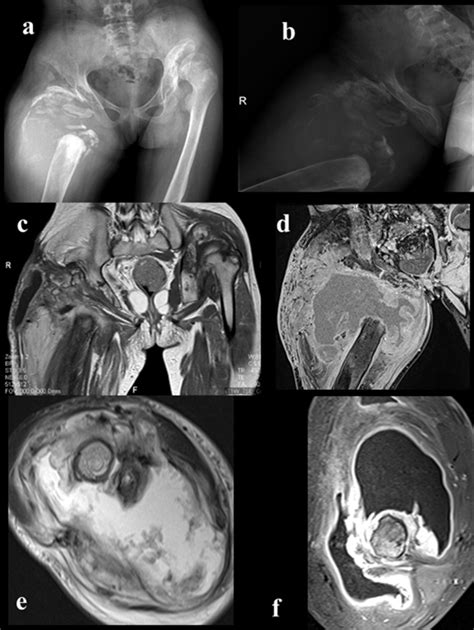 Congenital Insensitivity to Pain Syndrome with Anhidrosis. Review of ...