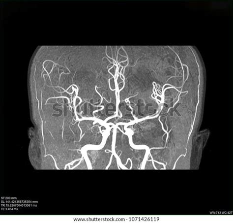 Mri Blood Vessels Brain Cerebrovascular Disease Stock Photo (Edit Now ...