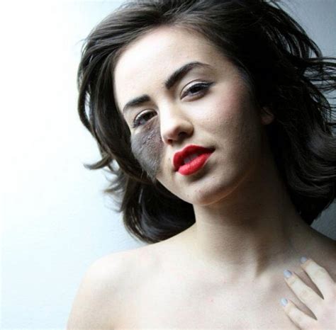 Cassandra Naud Birthmark