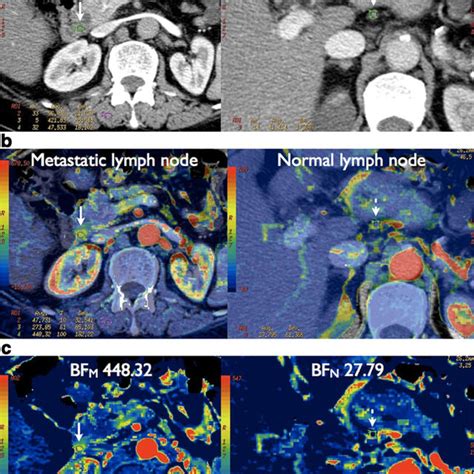 Pct Of Peripancreatic Lymph Node Left Arrow And Of A Normal Lesser